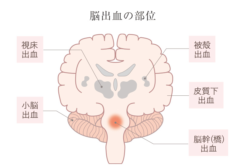 脳出血を起こす部位のイラスト画像
