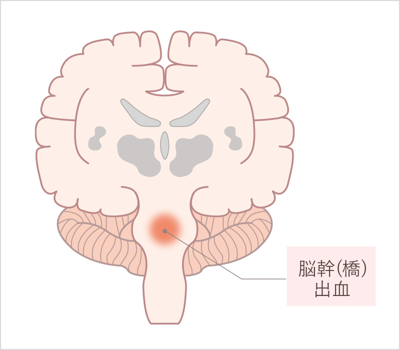 脳幹(橋)出血