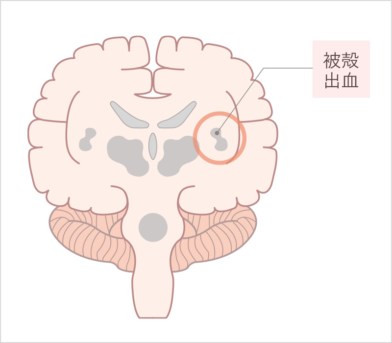 被殻出血