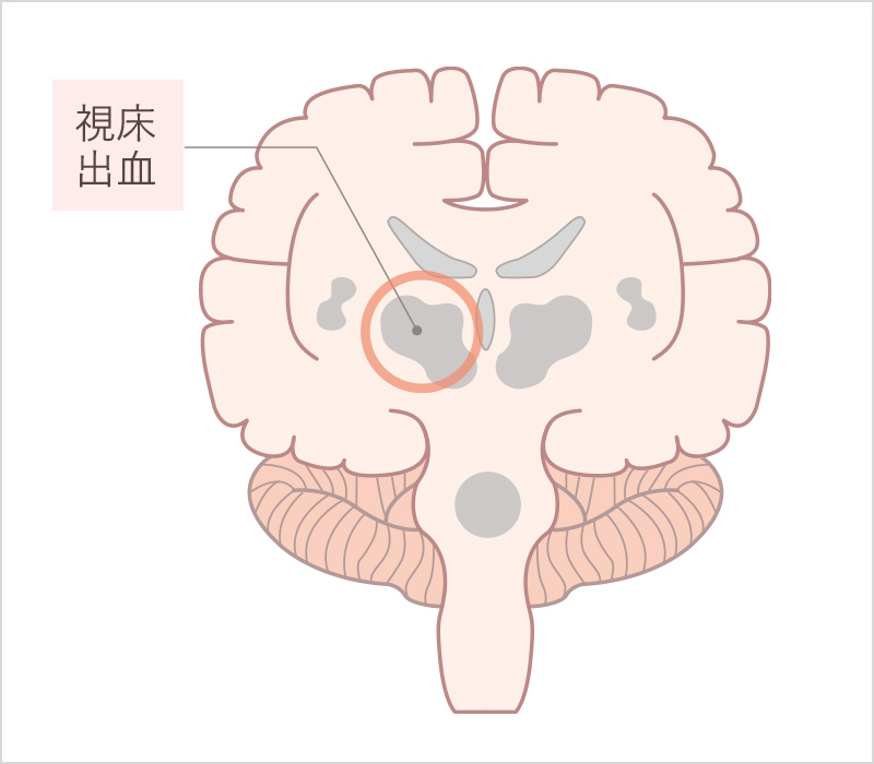 視床出血