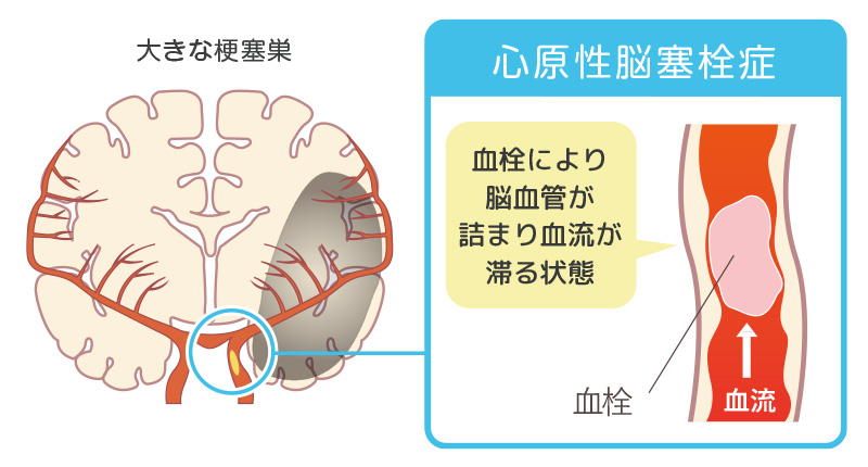 心原性脳梗塞