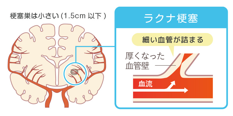 ラクナ梗塞