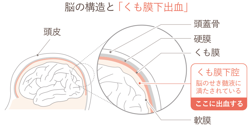 くも膜下出血とは軟膜とくも膜の間にあるくも膜下腔の出血