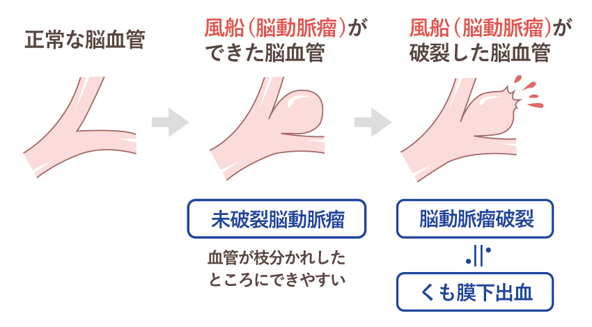 脳動脈瘤の破裂によるくも膜下出血