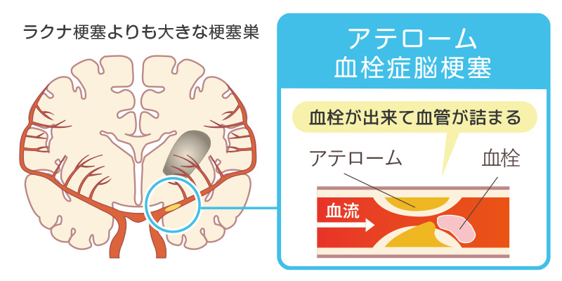 アテローム血栓性脳梗塞