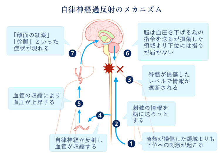 自律神経過反射のメカニズム(機序)