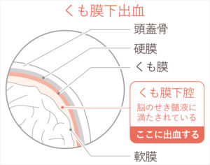 くも膜下出血