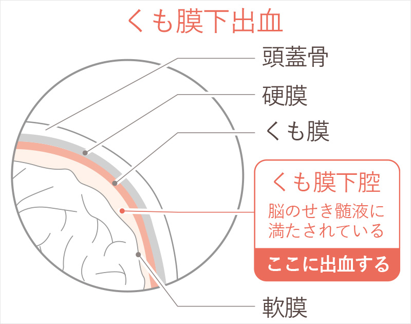 くも膜下出血について